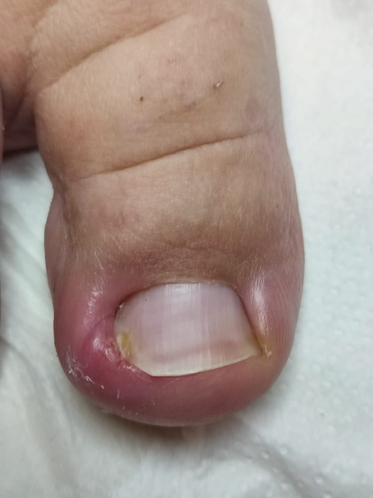 BATIK TIRNAK TEDAVİSİNDE NİCEA PODOLOJİ EKİBİ OLARAK NELER YAPIYORUZ? - Resim 3